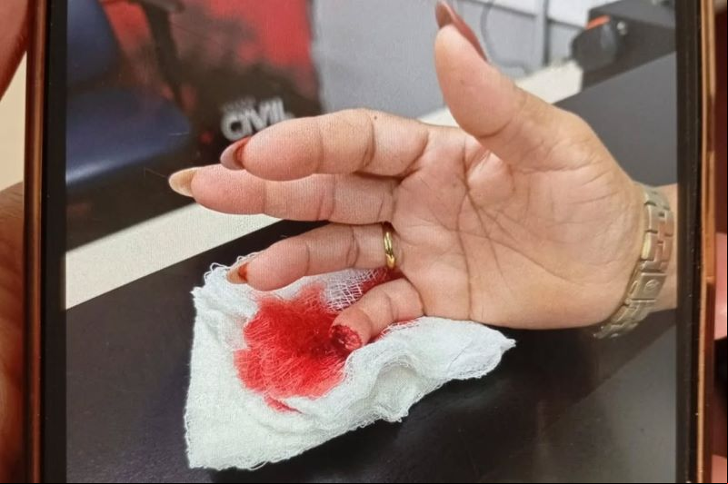 D. Noélia teve parte do dedo mindinho decepada.
